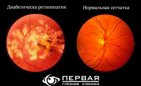 lehenie_diabetic_retinopathy.jpg