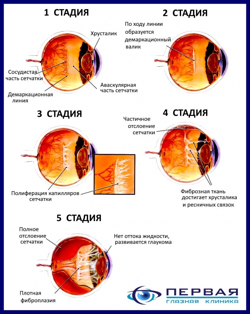 Ретинопатия Московская глазная клиника.jpg