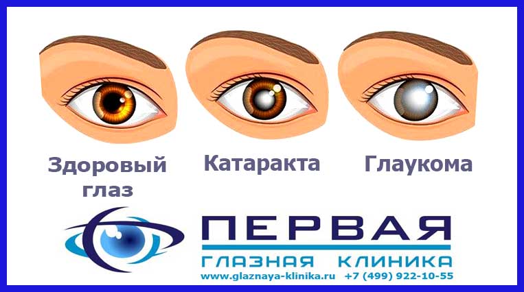 Глаукома Glaucoma глазная клиника 1.jpg