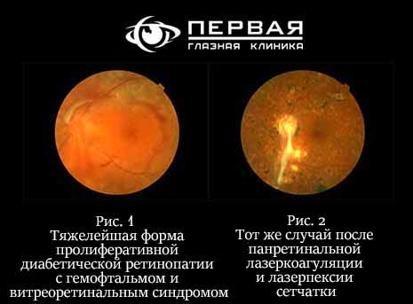 lehenie_diabetiheskoi_retinopatii_sethatca_glaza.jpg