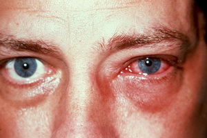 Химические ожоги глаз.jpg
