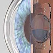 Новая интраокулярная линза поможет в борьбе с глаукомой