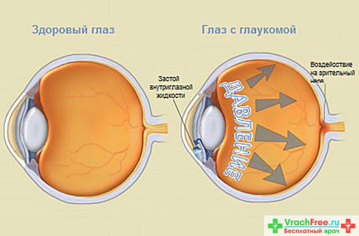 Глаукома – опасный враг для глаз