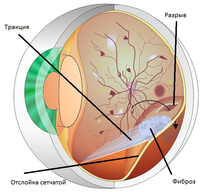 Зрение после отслойки. Диабетическая ретинопатия сетчатки глаза что это такое. Тракционная отслойка сетчатки глаза. Диабетическая ретинопатия отслойка сетчатки. Диабетическая ретинопатия глаз.
