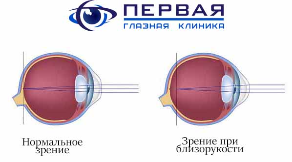 Как улучшить зрение при миопии?
