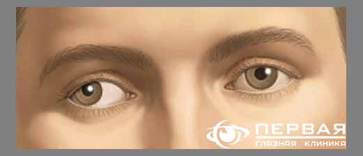 Ленивый глаз у ребенка: причины, симптомы и лечение | «Первая Глазная Клиника»