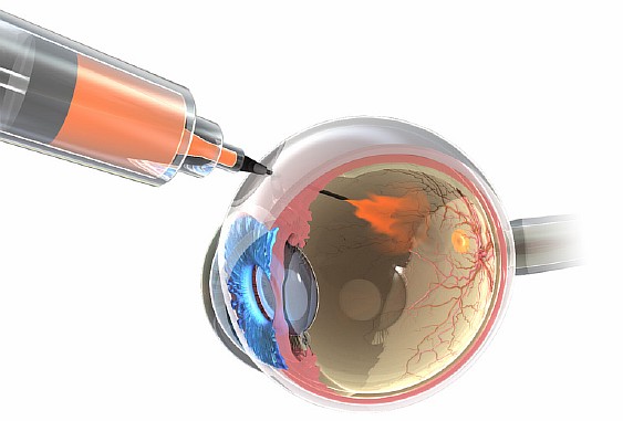 операция на сетчатке глаза: цена