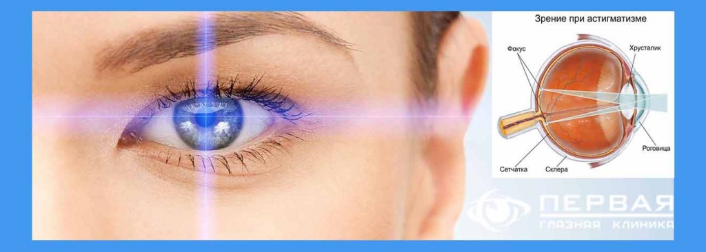 eye-astigmatizm-clinica.jpg