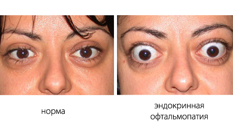 эндокринная офтальмопатия.jpg