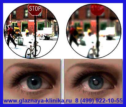 Зрение при катаракте Первая глазная клиника 1.jpg