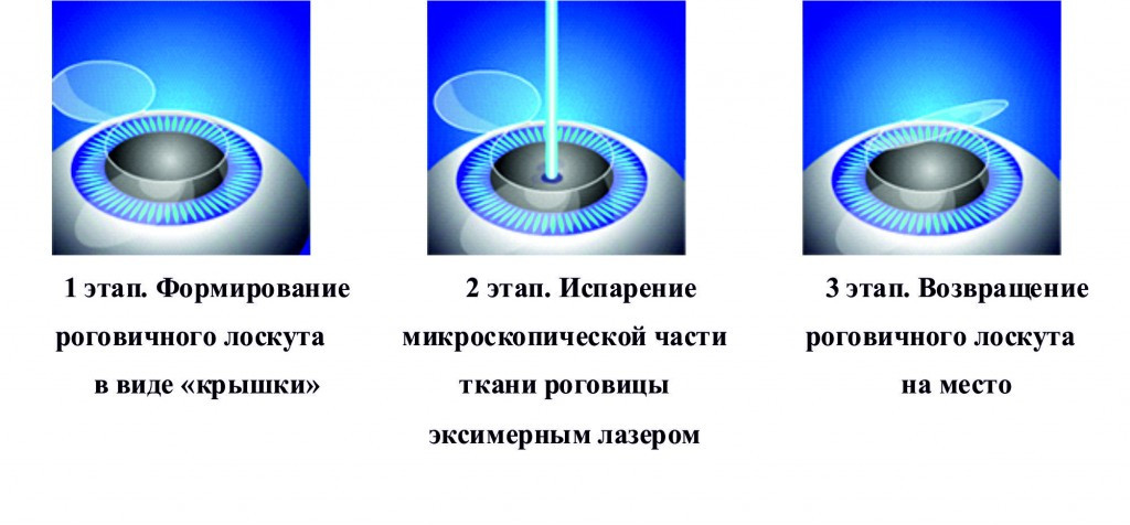 Лазерная коррекция зрения 2024. Коррекция зрения методом ласик. Лазерная коррекция зрения методом Femto-LASIK. Лазерная коррекция зрения принцип метода. Лазерный кератомилез in situ ласик.