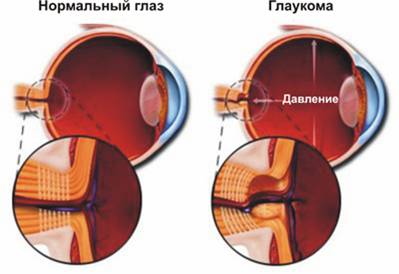 лечение глаукомы лазером
