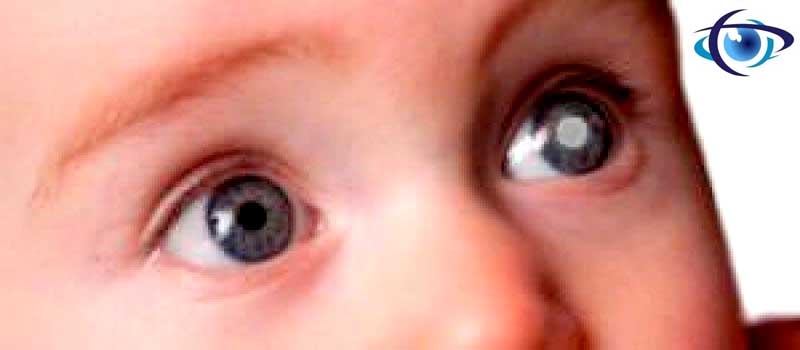 katarakta deti детская катаракта.jpg