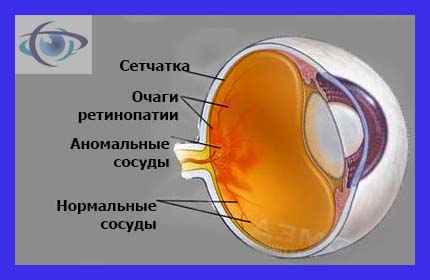 lechenie diabeta glaza ретинопатия.jpg