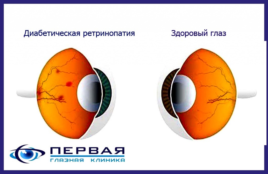 diabeticheskaja-forma-retinopatii Диапетическая ретинопатия Первая глазная клиника.jpg